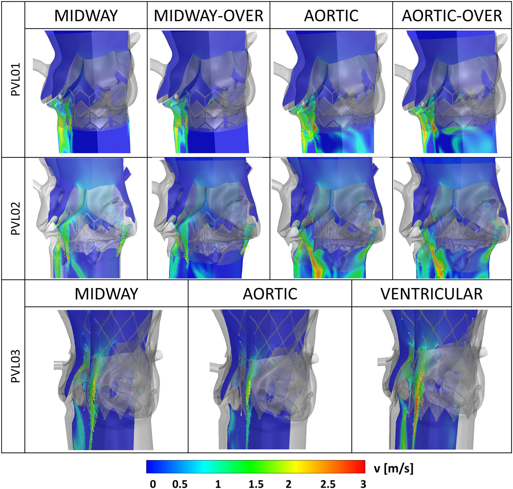 TAV patient model deployment